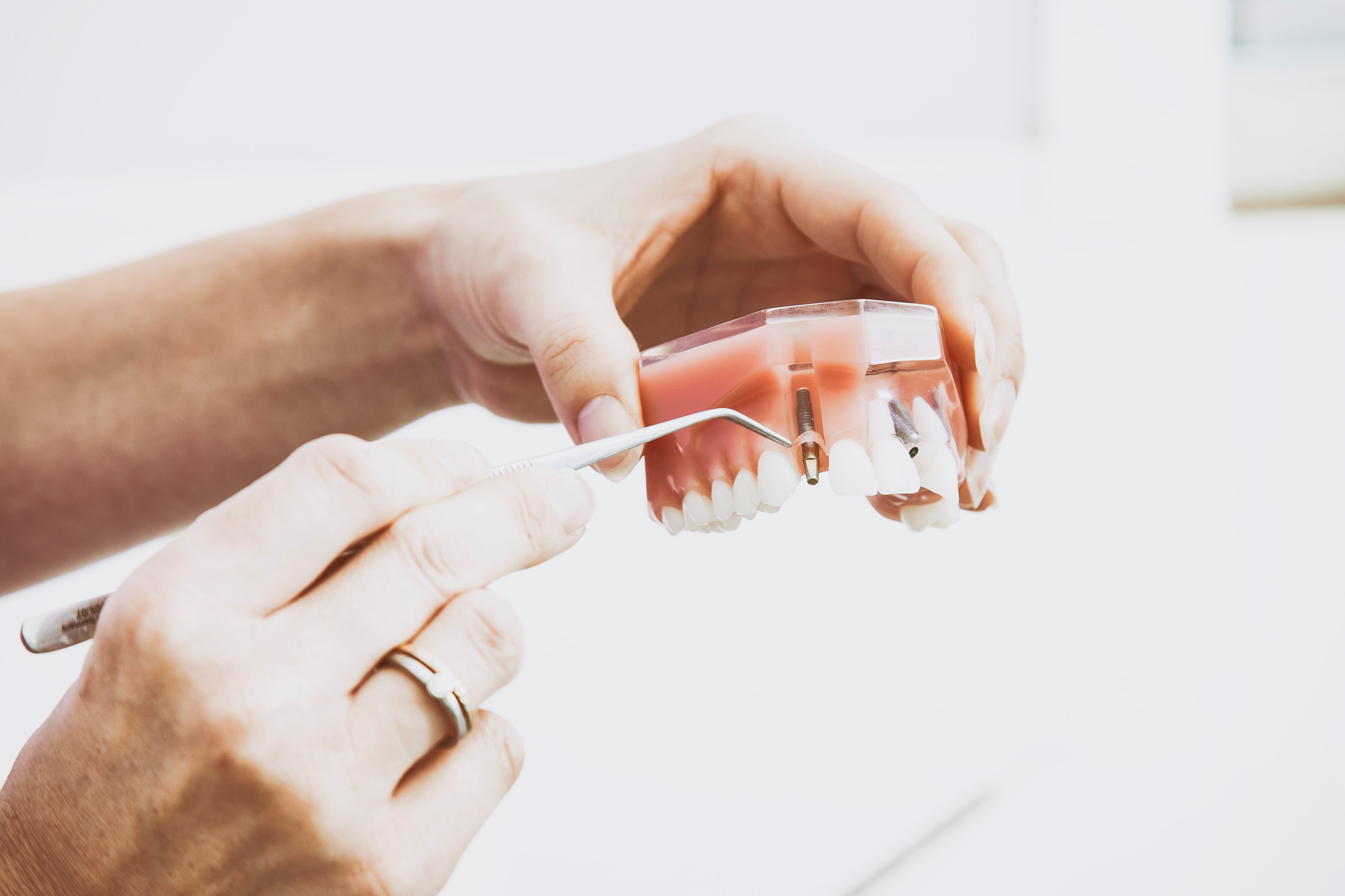 Implantologia a carico immediato - Studio dentistico Wdent