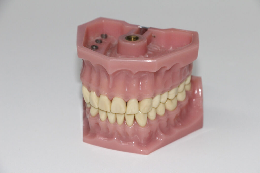 Costo impianto dentale